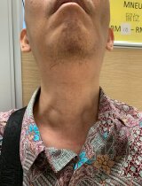 肌肉強直症 香港神經肌肉疾病學會